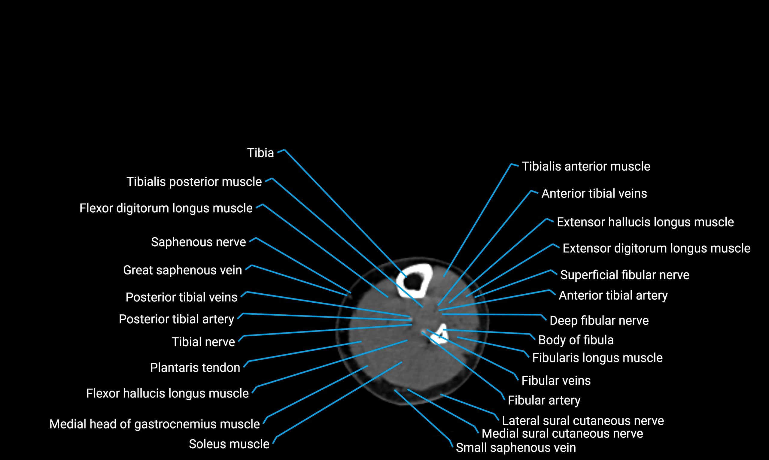 CT lower limb axial cross sectional anatomy labelled image 120 (2).webp